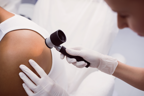 Skin Cancer ABCs