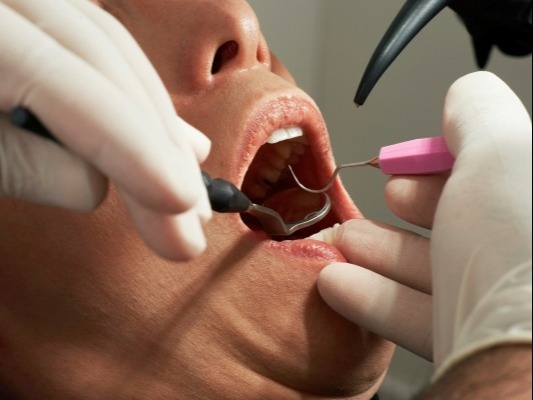 The Price of a Perfect Smile: Understanding the Cost of Major Dental Work