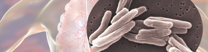 What Everything Is Tuberculosis Can Teach Us About Financial Planning